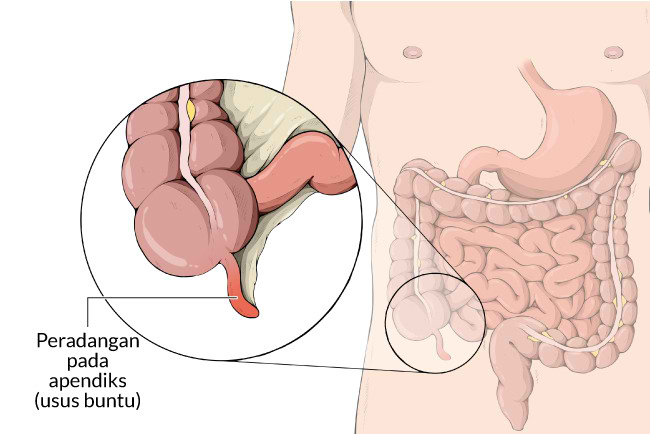 APENDISITIS AKUT
